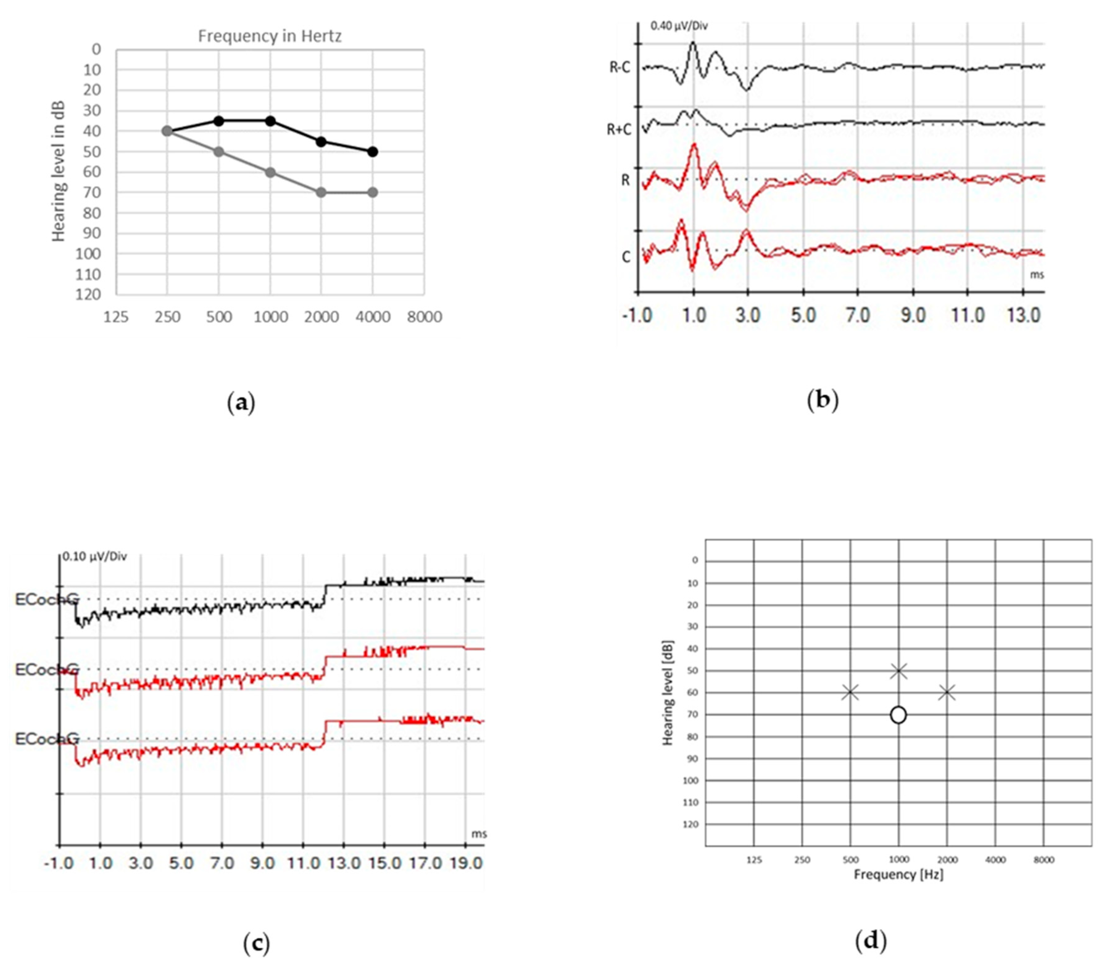 PDF] Brainstem evoked response audiometry and risk factors in premature  infants