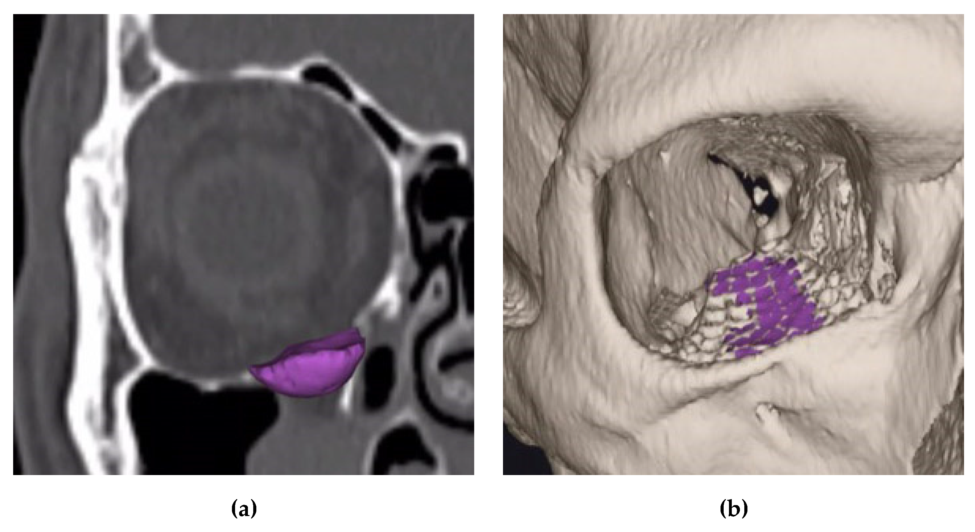 Jcm Free Full Text Three Dimensional Analysis Of Isolated Orbital Floor Fractures Pre And Post Reconstruction With Standard Titanium Meshes Hybrid Patient Specific Implants