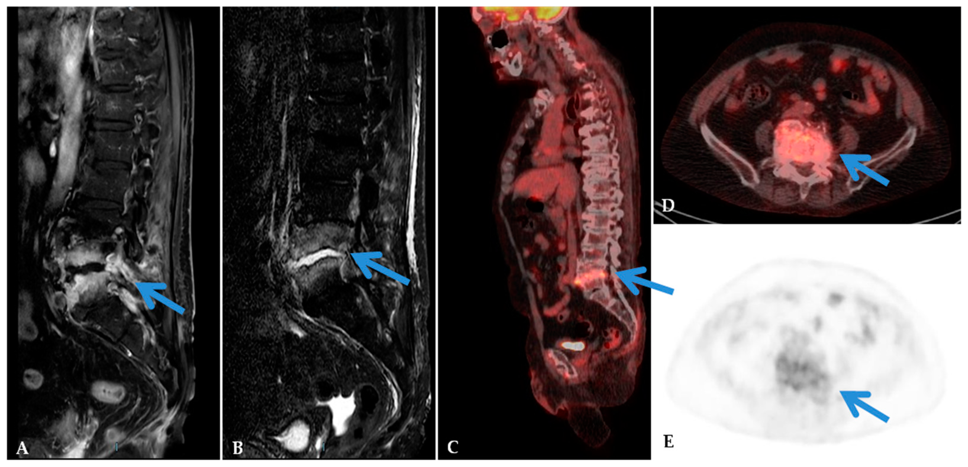 JCM Free Full-Text | Comparison of the Diagnostic Value MRI and Whole Body 18F-FDG PET/CT Diagnosis of Spondylodiscitis