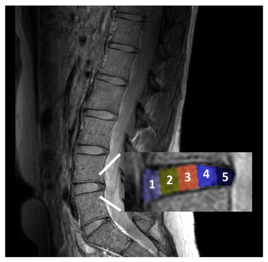 JCM | Free Full-Text | Characterization of Intervertebral Disc Changes ...