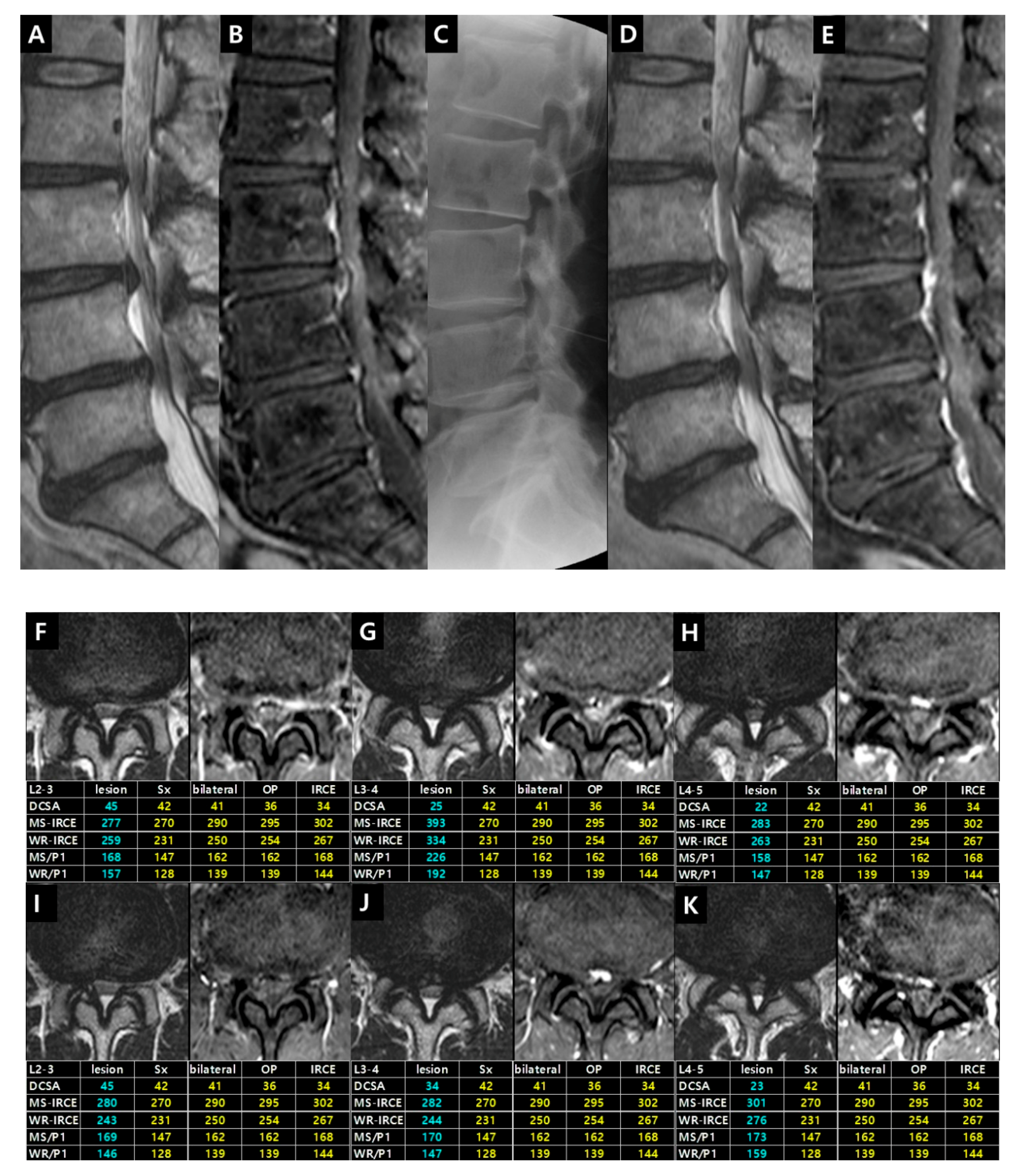 Assessment of degenerative cervical stenosis on T2-weighted MR imaging:  sensitivity to change and reliability of mid-sagittal and axial plane  metrics