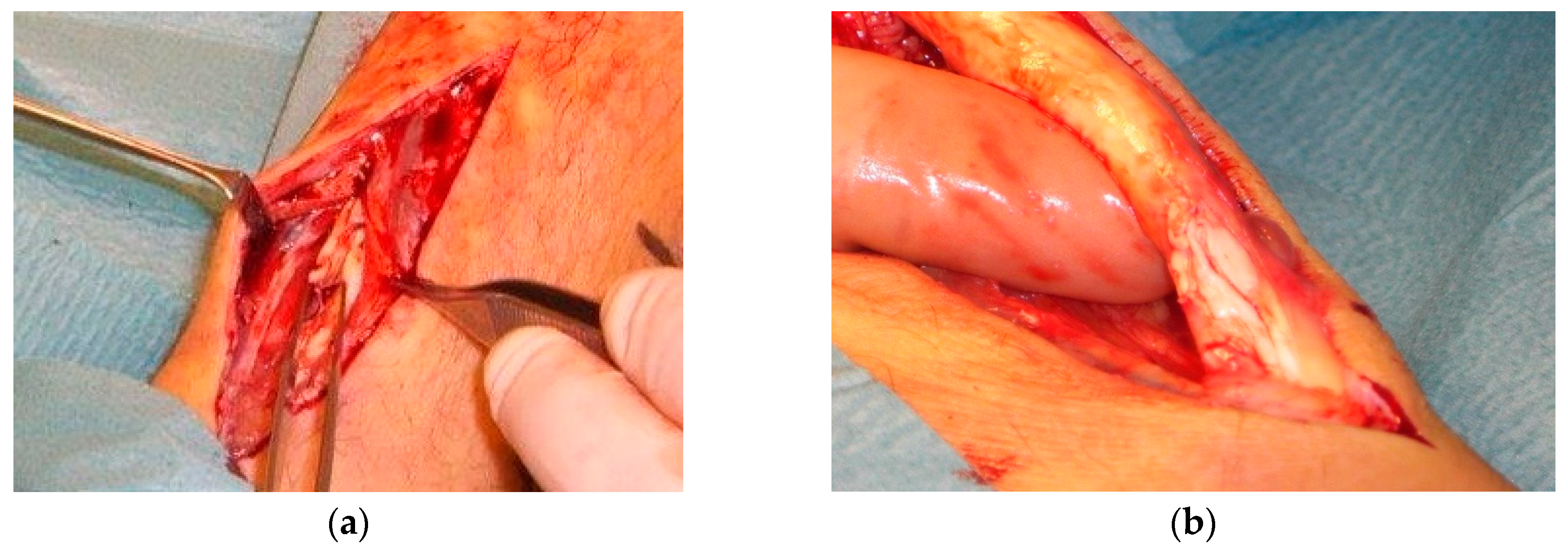 Achilles Tendon Repair Surgery Post-operative Instructions Phase