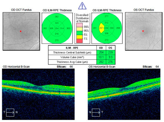 Fluid Under Rpe Short Term Presence of Subretinal Fluid in Central Serous ...
