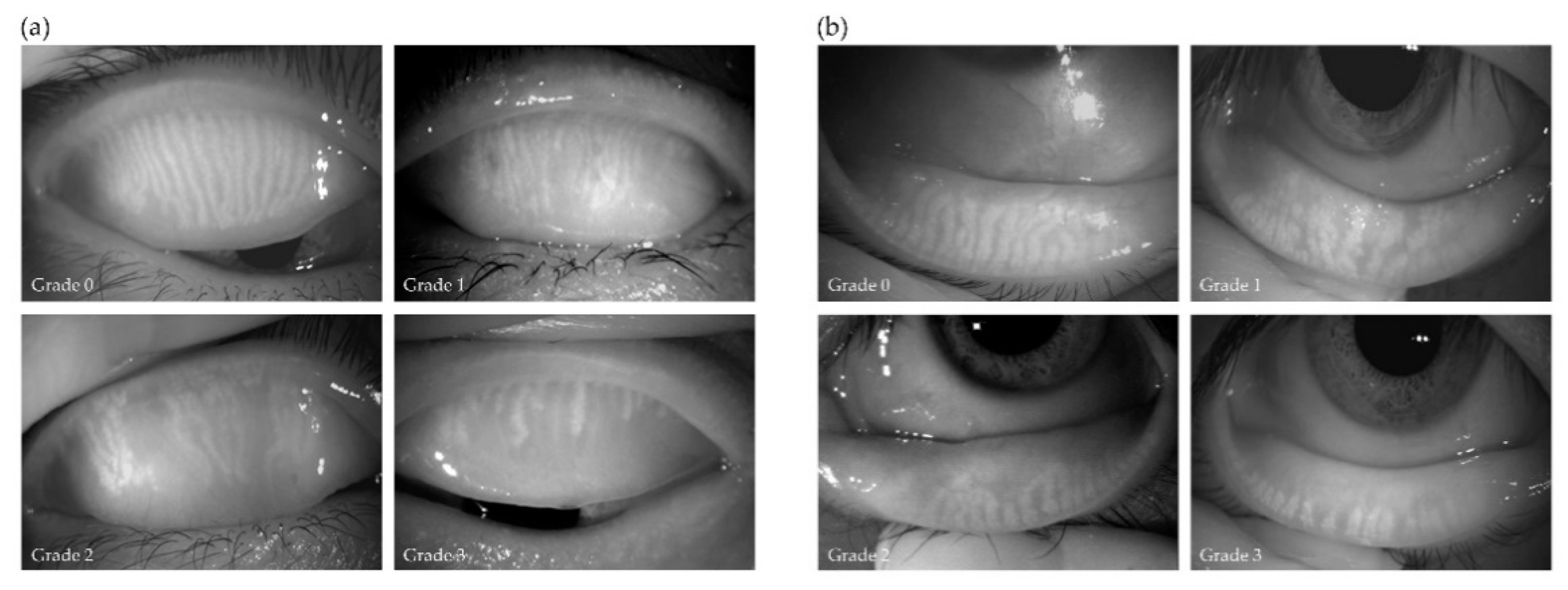 meibomian gland dysfunction expression