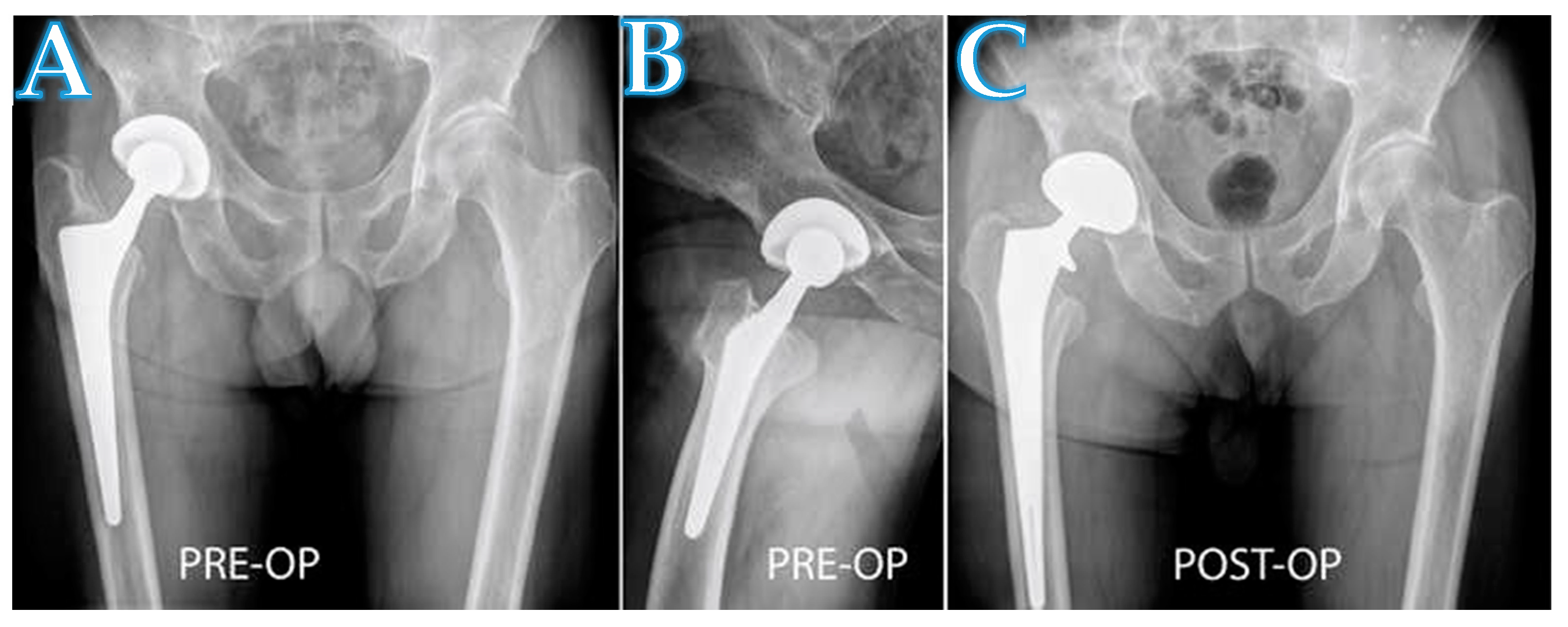 Total Hip replacement(posterior approach): Exeter femoral stem and
