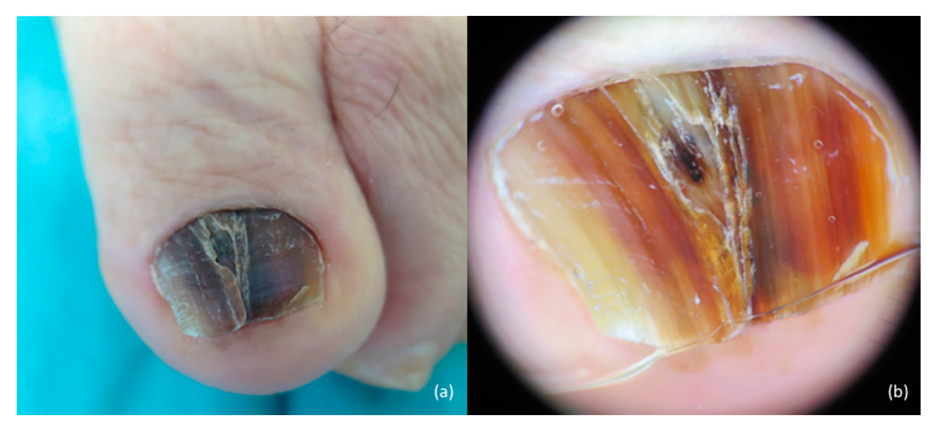 JCM | Free Full-Text | Cutaneous and Mucosal Melanomas of Uncommon Sites:  Where Do We Stand Now?
