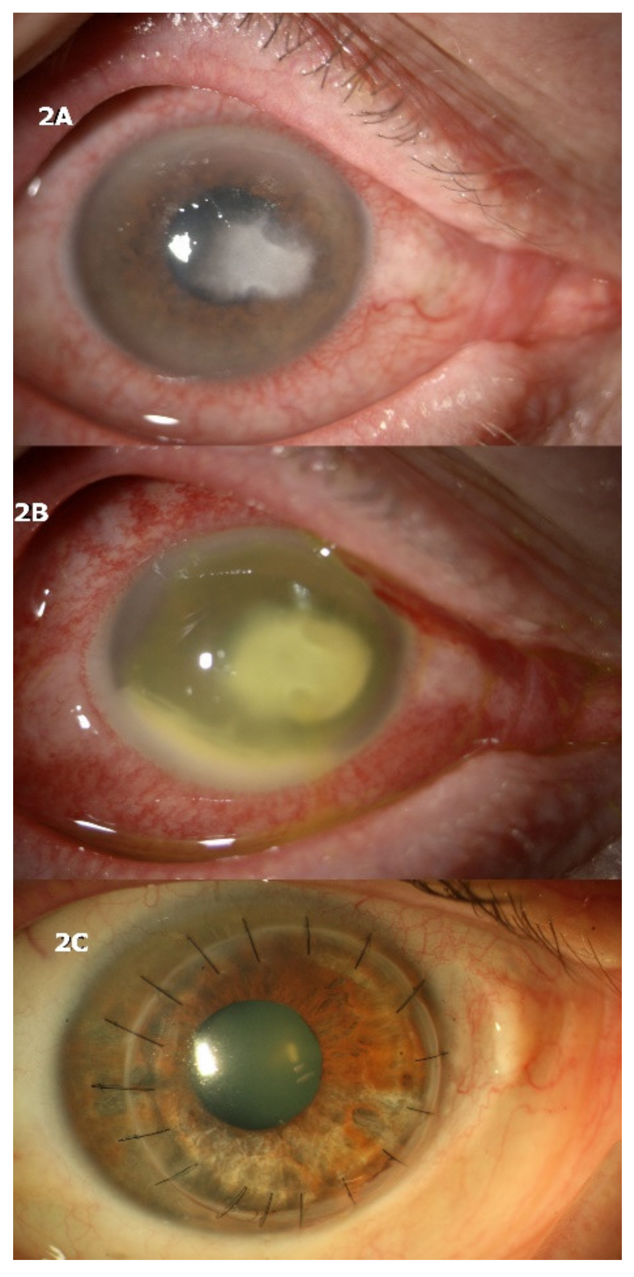 Nummular Keratitis Nummular Keratitis