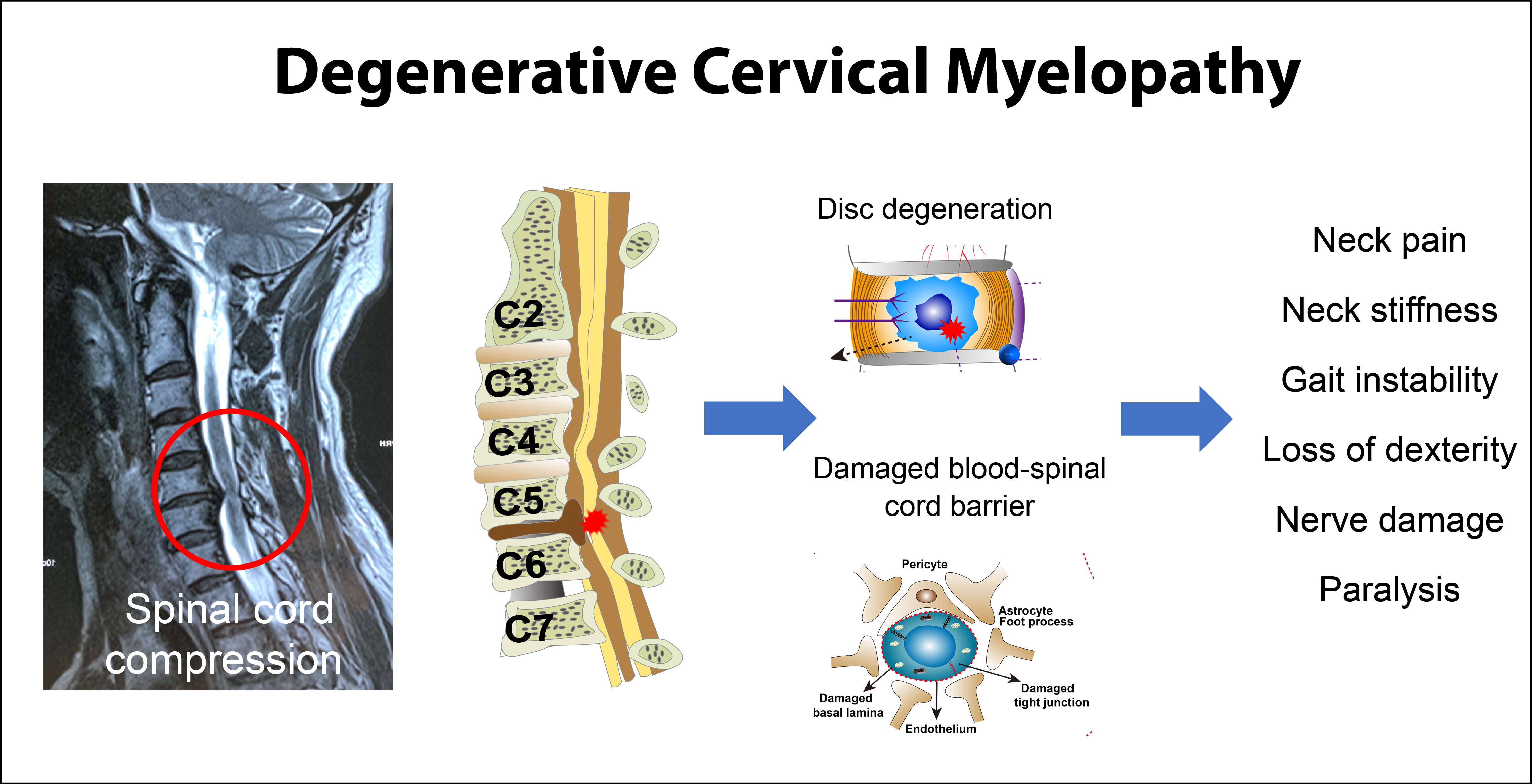 JCM | Free Full-Text | Degenerative Cervical Myelopathy: Insights