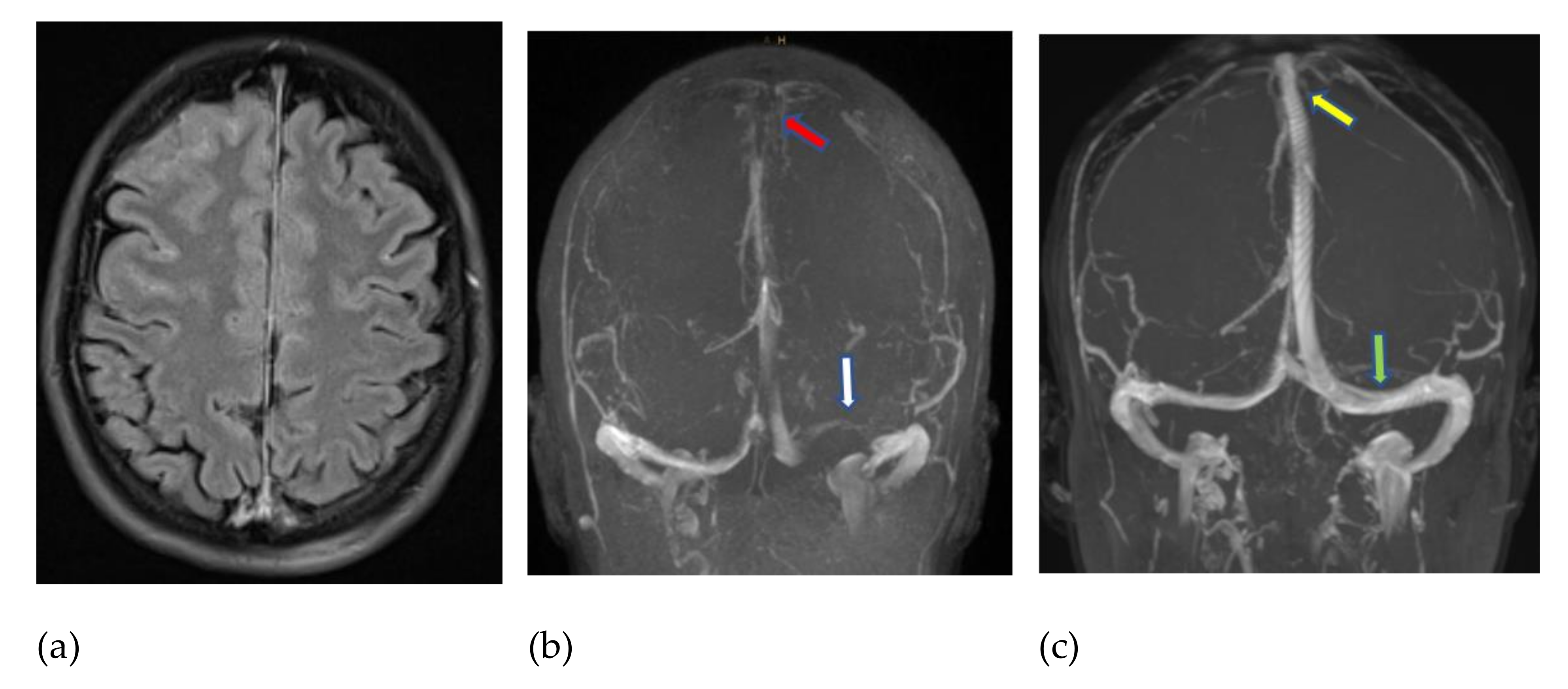 JCM | Free Full-Text | Thrombocytopenia and Intracranial Venous Sinus  Thrombosis after “COVID-19 Vaccine AstraZeneca” Exposure