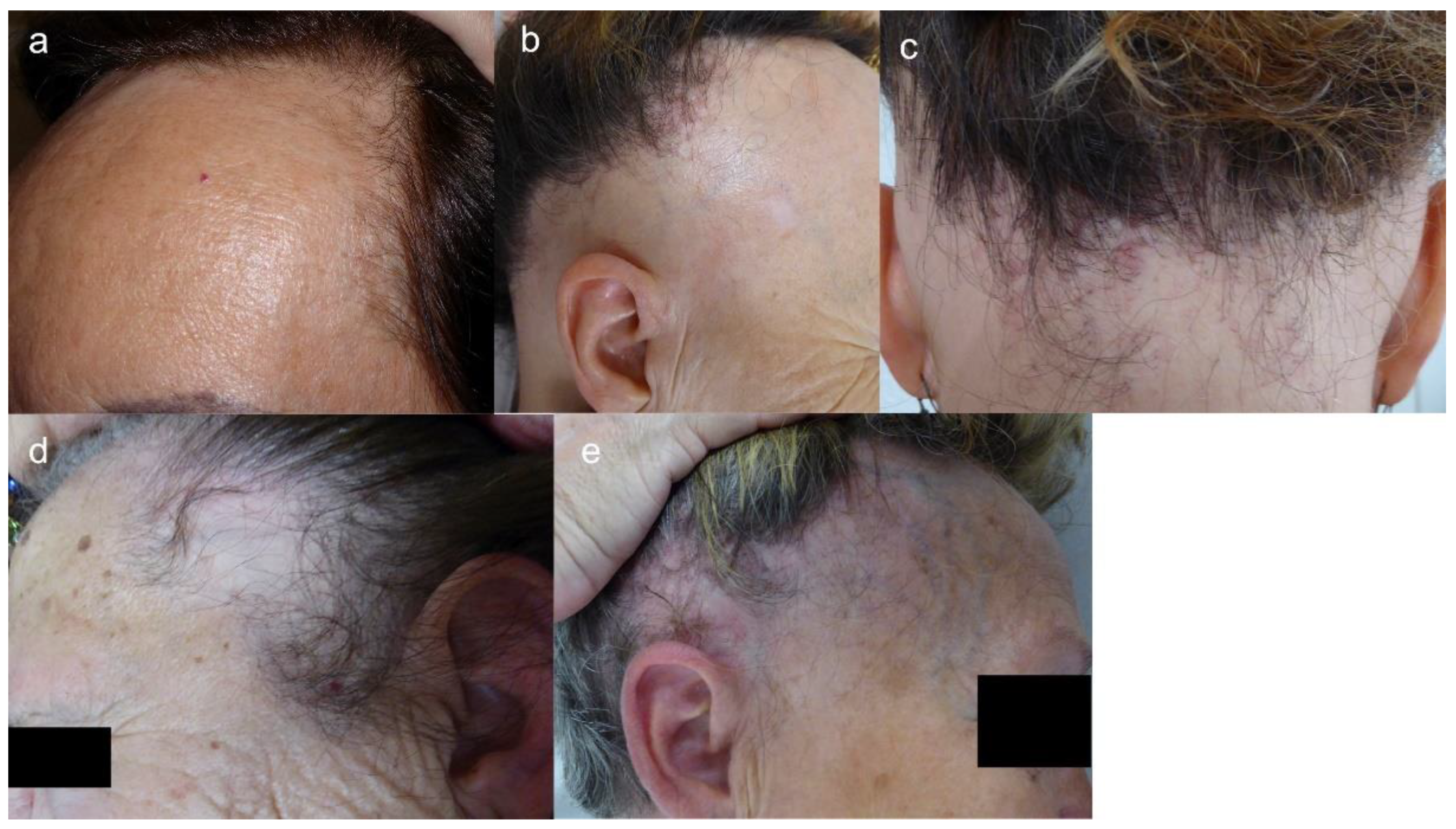 Frontal Fibrosing Alopecia FFA Causes Treatment and Diet