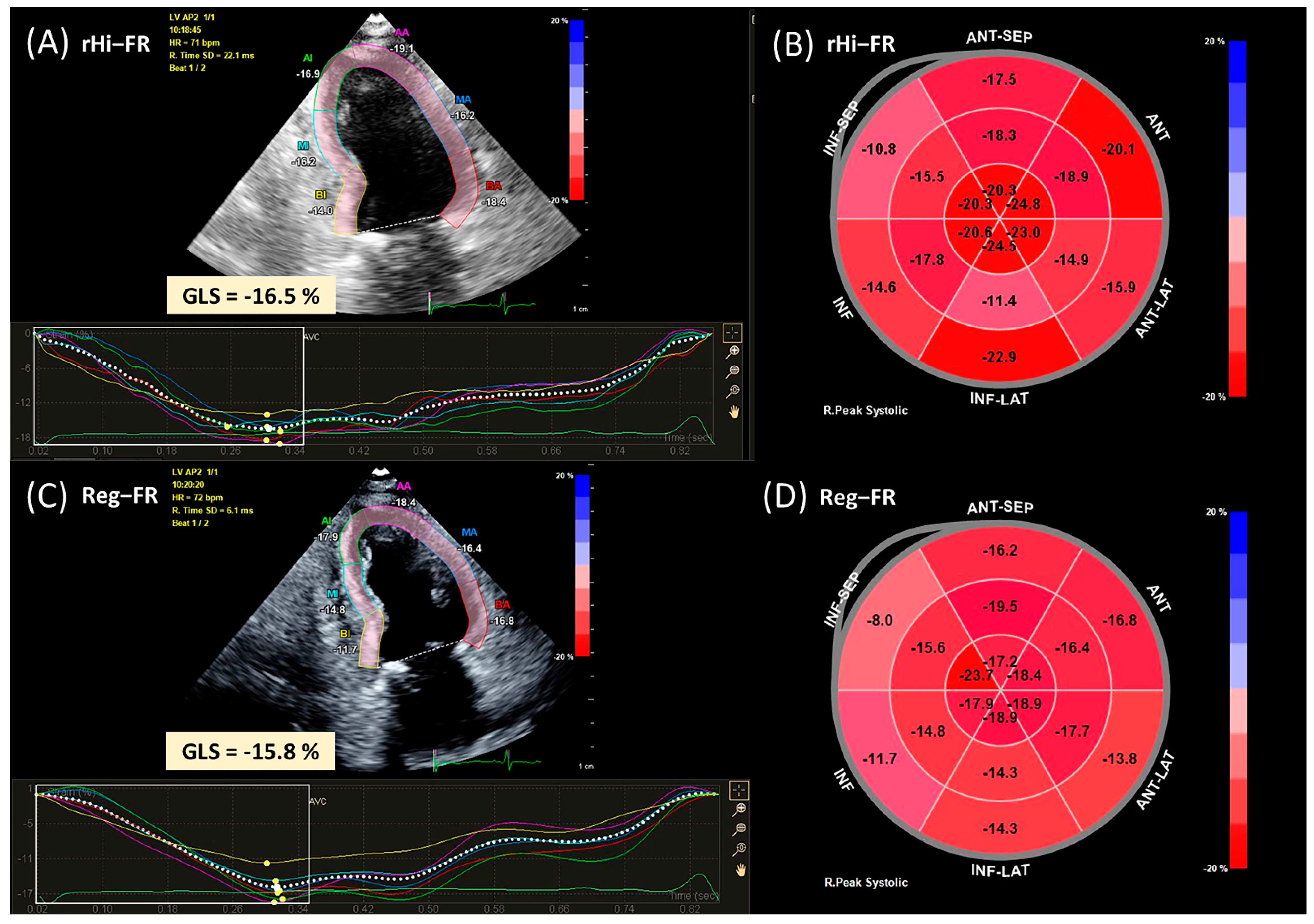 Evaluation of Subclinical LV Systolic Dysfunction by GLS Using 2D-STE