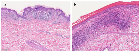 JCM | Free Full-Text | Pigmented Purpuric Dermatoses: A Complete ...