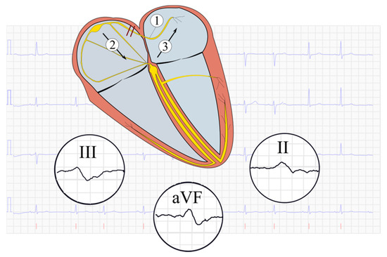 JCM | Free Full-Text | The Prevalence of Advanced Interatrial Block and ...