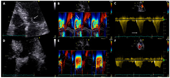 JCM | Special Issue : Hypertrophic Cardiomyopathy: Phenotypes and ...