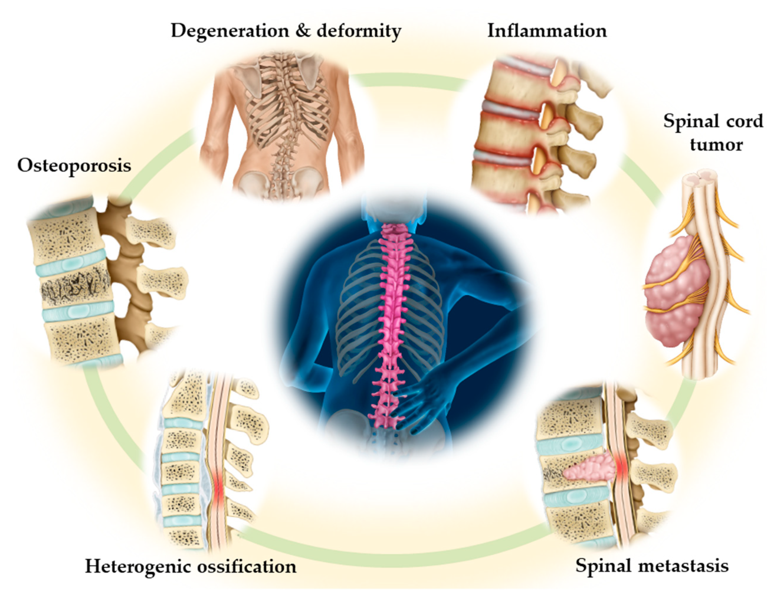 JCM | Free Full-Text | Current Advances in Spinal Diseases of the 