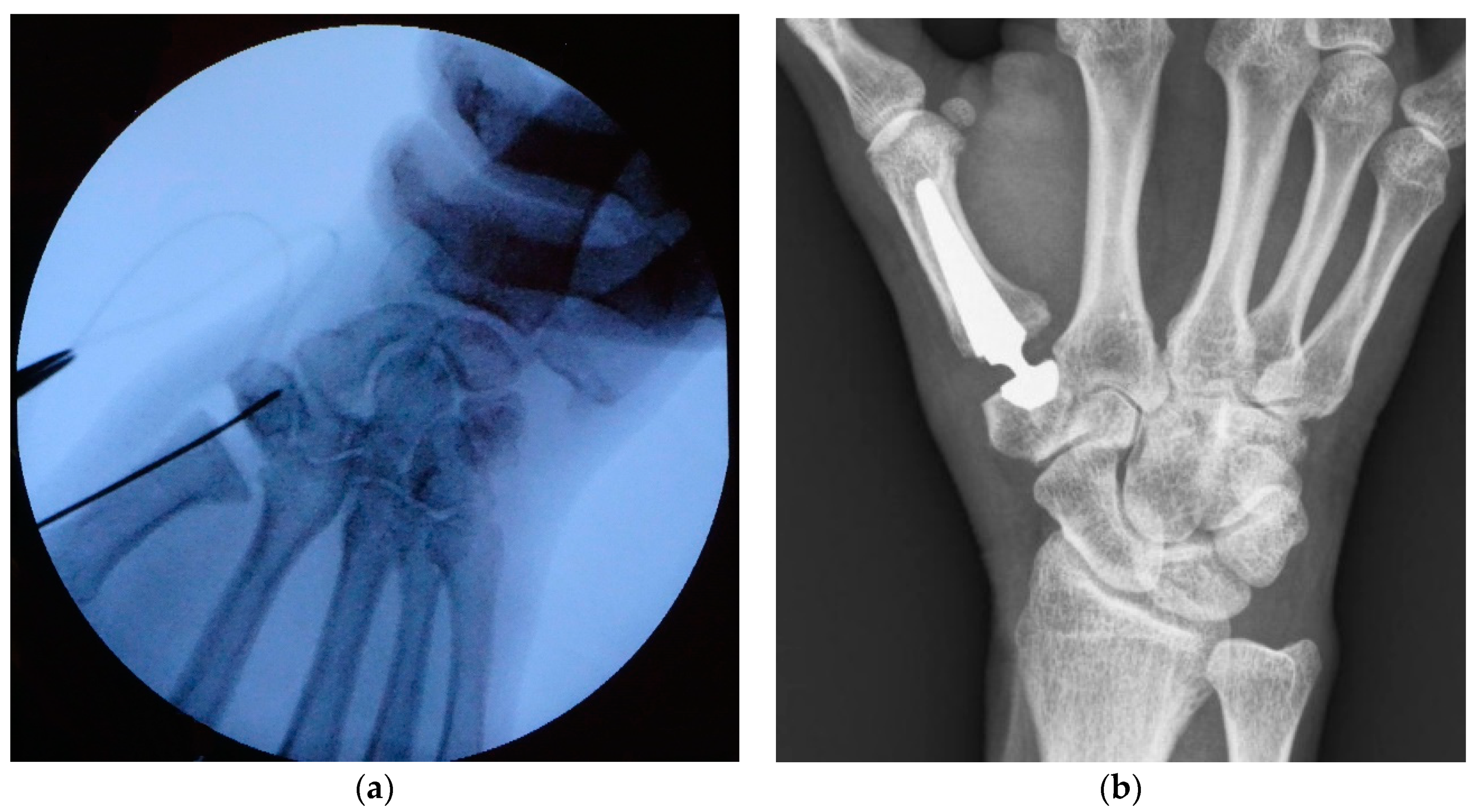 TOUCH Prosthesis For Thumb Carpometacarpal Joint Osteoarthritis A TOUCH Prosthesis For Thumb Carpometacarpal Joint Osteoarthritis A