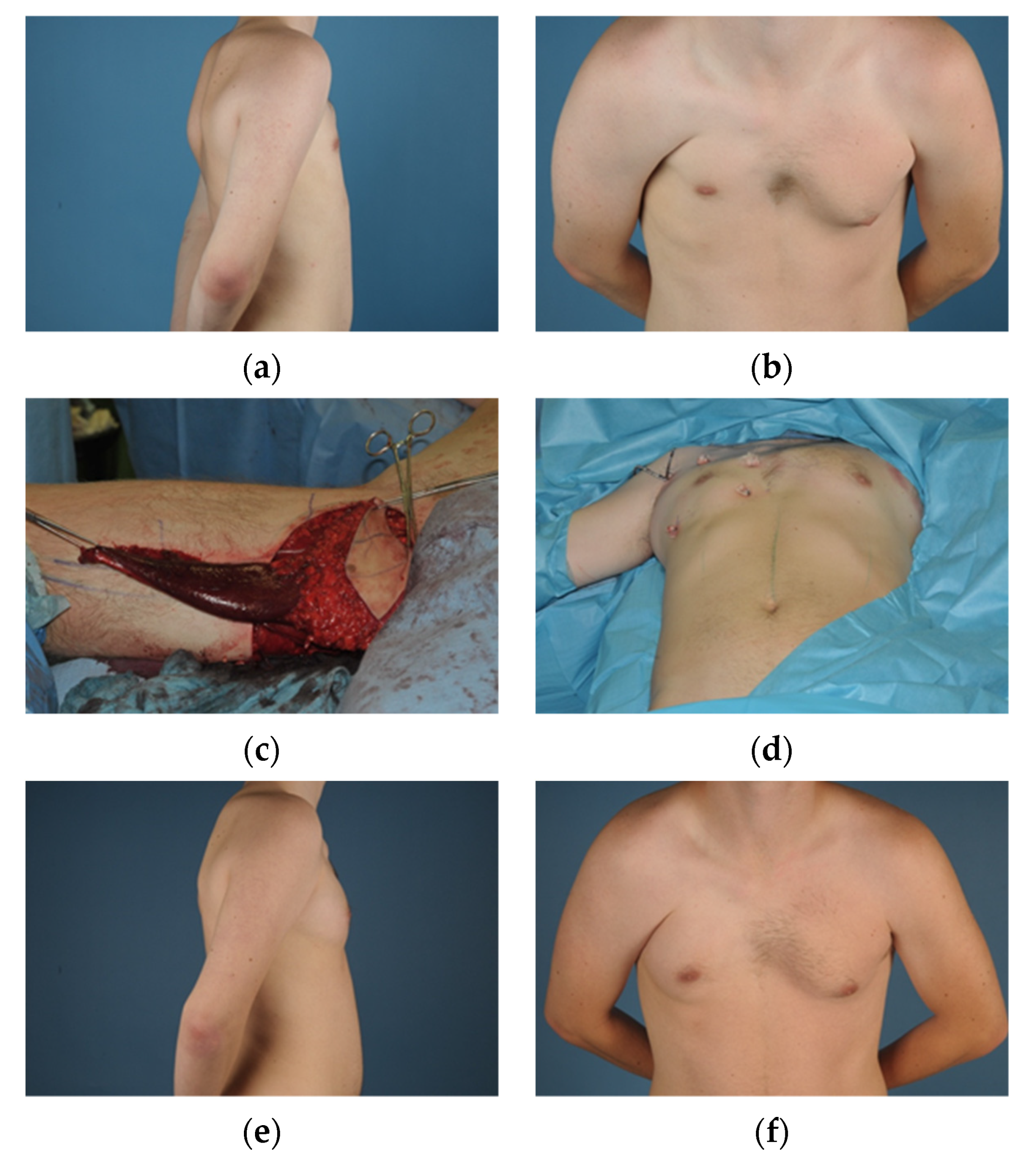 A, Breast appearance before transgender top surgery. B, Results