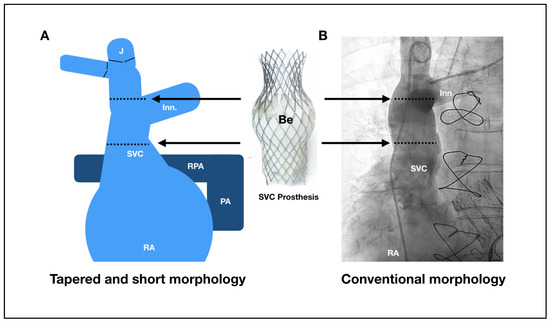 Description, Feasibility, and Histological Assessment of the Vsling, a  Novel Transcatheter Ventricular Repair Device - ScienceDirect