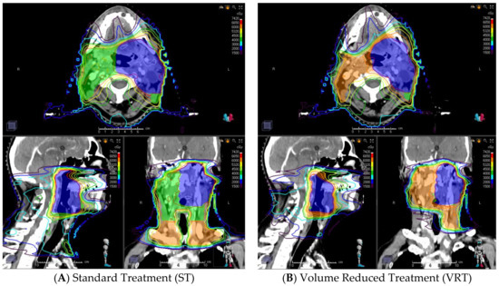 JCM | Free Full-Text | Reduction of Elective Radiotherapy Treatment ...