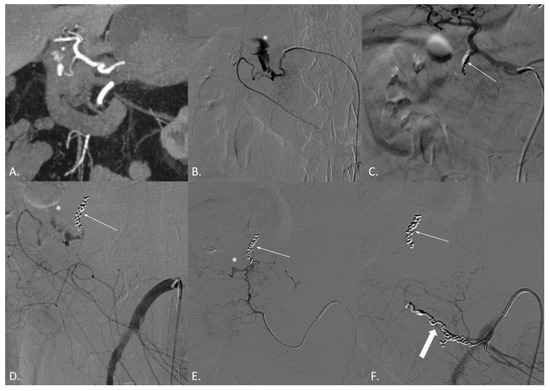 Transcatheter Arterial Embolization in Acute Non-Variceal