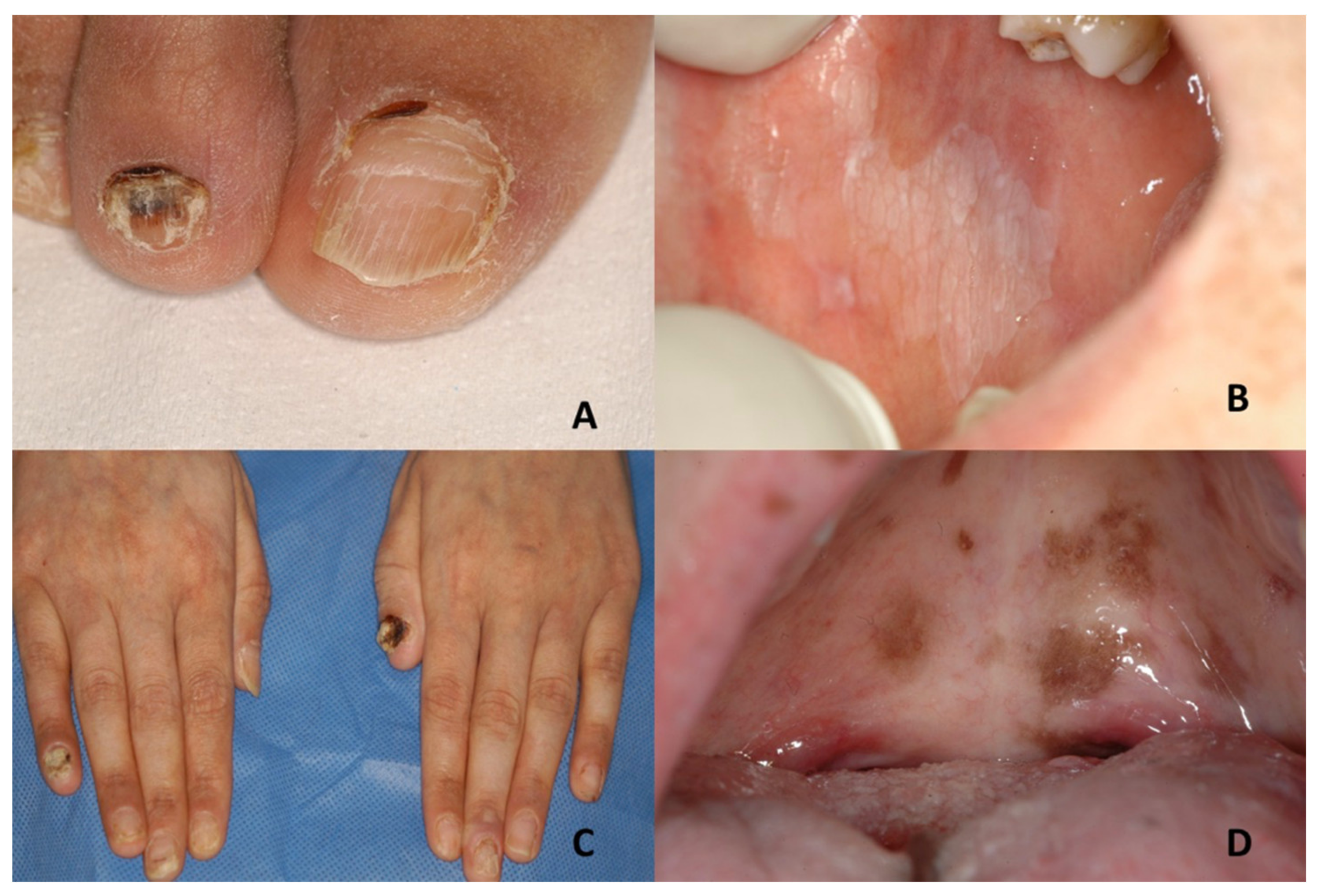 File:Hypopigmented macules, Shagreen patch and periungual fibroma of tuberous  sclerosis.png - Wikipedia