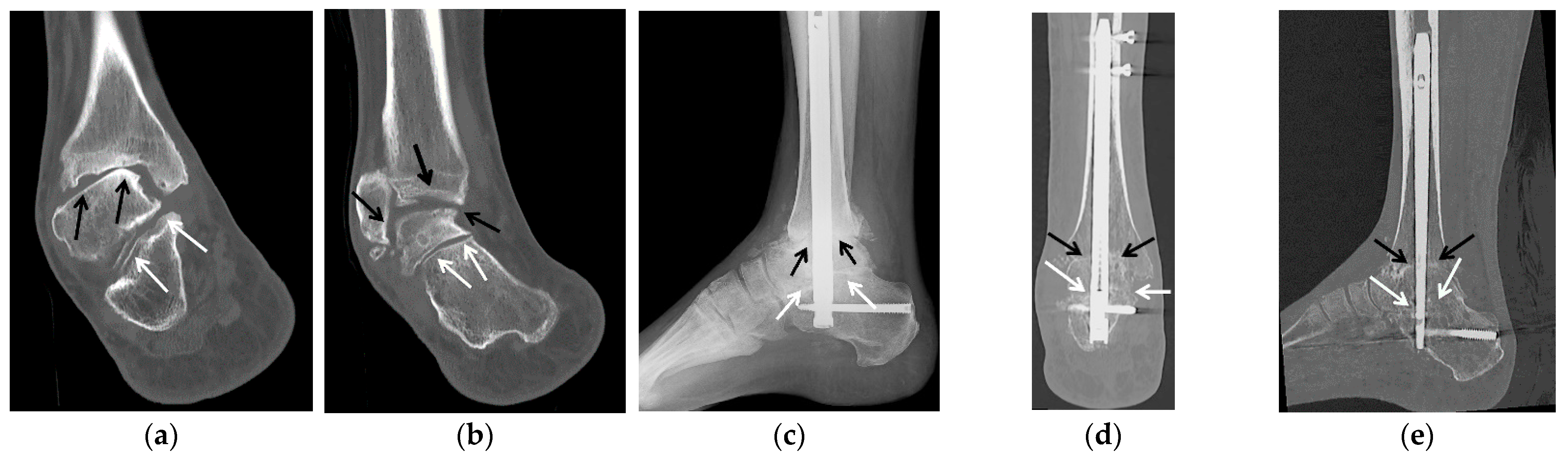JCM | Free Full-Text | Imaging and Treatment of Posttraumatic Ankle and  Hindfoot Osteoarthritis