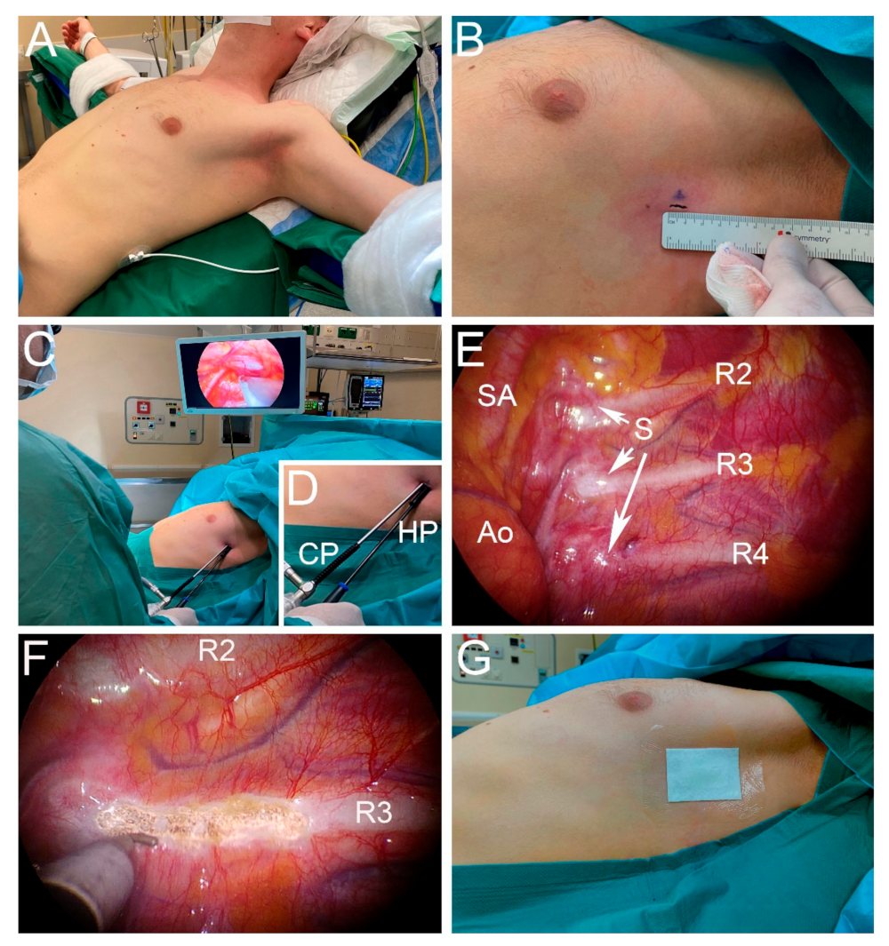 Facebook 786 Xxx Video - JCM | Free Full-Text | Minimally Invasive Sympathicotomy for Palmar  Hyperhidrosis and Facial Blushing: Current Status and the Hyperhidrosis  Expert Center Approach
