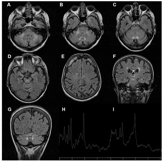 Fragile X Associated Tremor Ataxia Syndrome FXTAS A Gender Perspective Fragile X Associated Tremor Ataxia Syndrome FXTAS A Gender Perspective