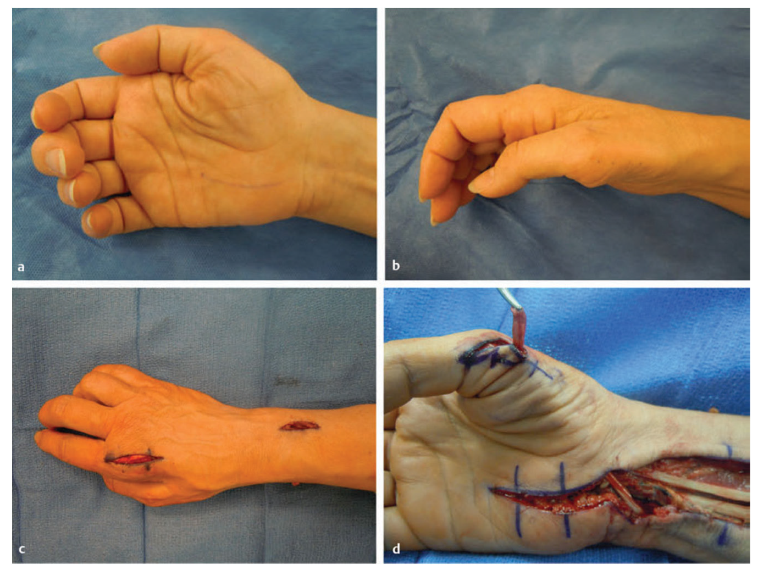 JCM | Free Full-Text | Revision of Carpal Tunnel Surgery
