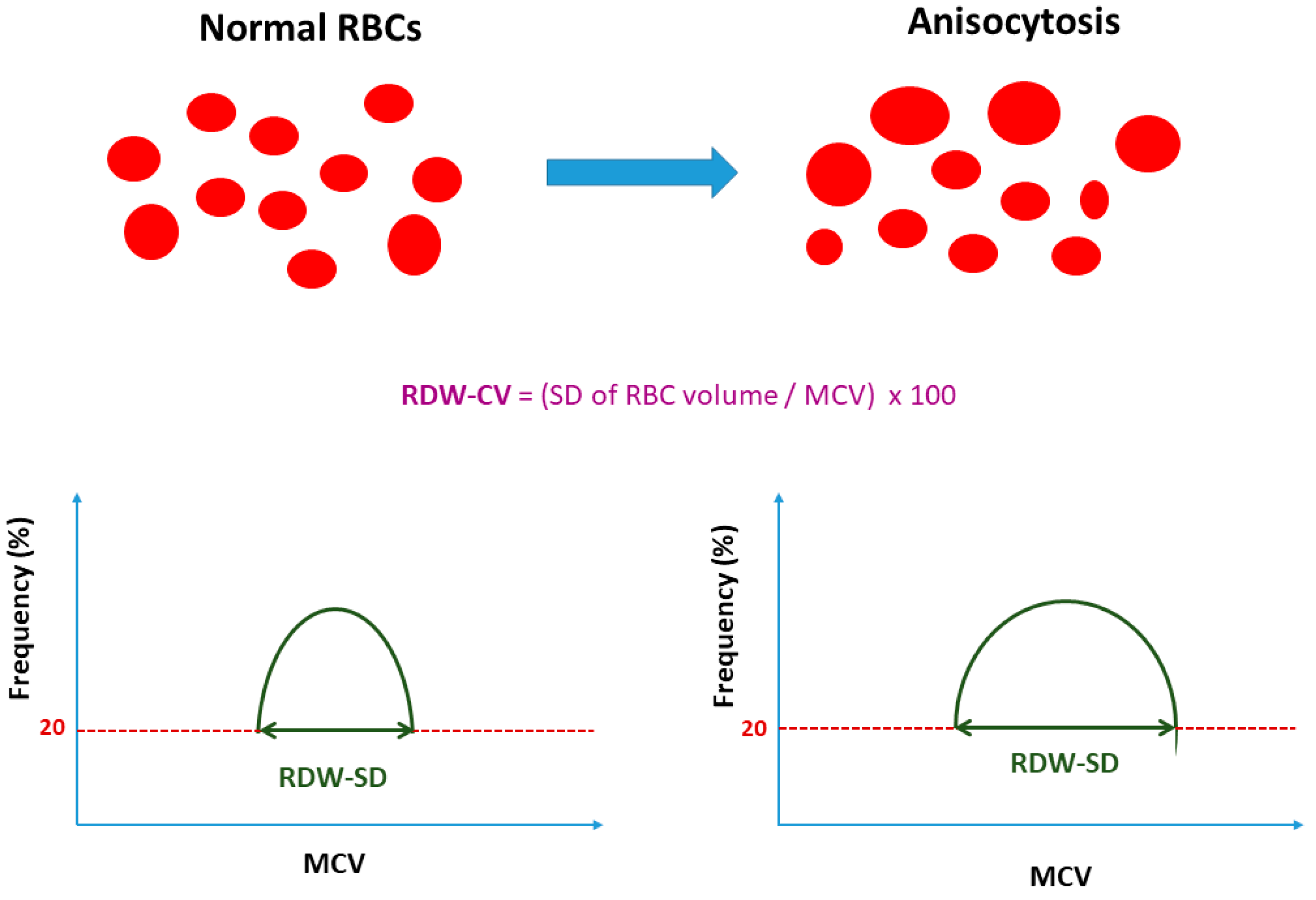 JCM | Free Full-Text | Red Blood Cell Width in Heart Failure: Pathophysiology, Prognostic Role, Controversies and Dilemmas