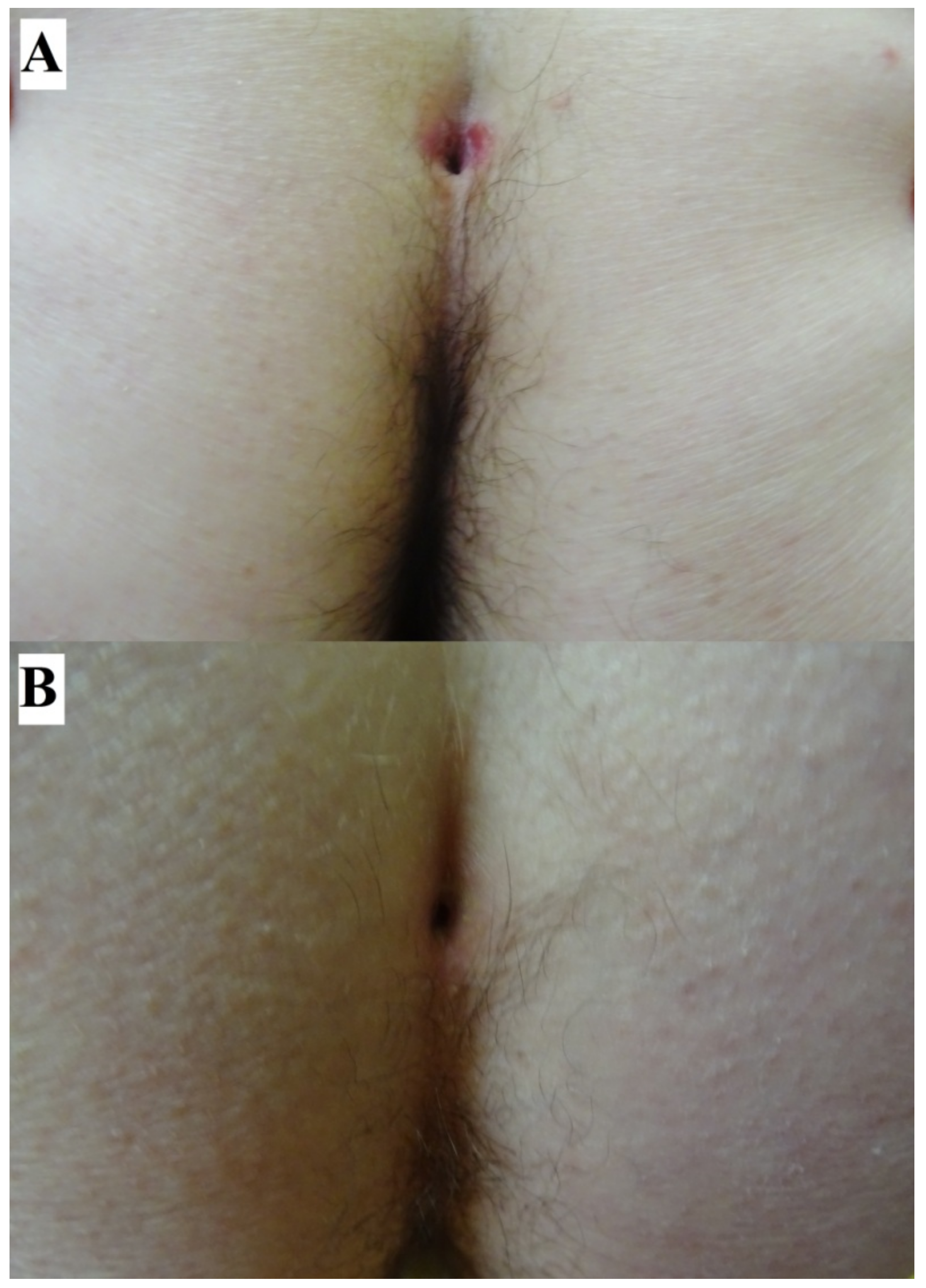 JCM | Free Full-Text | Sacral Dimple, Conjunctiva, and Nipple as Less  Obvious Pemphigus Vulgaris Locations around Natural Body Orifices: A Report  of Three Cases