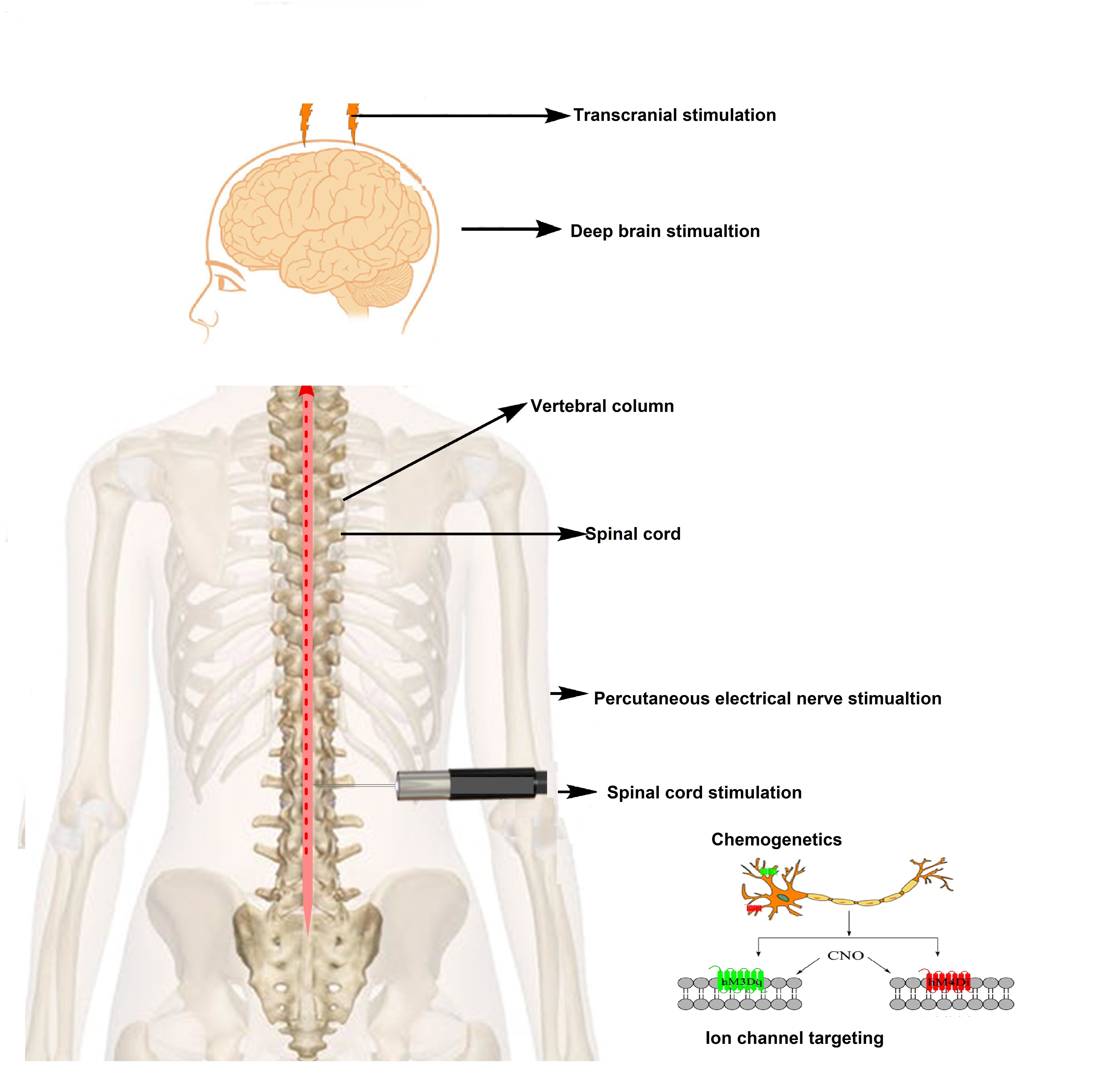 Peripheral Nerve Stimulators: Drug-Free, Low-Back Pain Relief