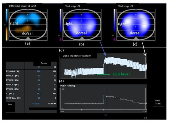 Clinical Implications of Determining Individualized Positive End-Expiratory Pressure Using Electrical Impedance Tomography in Post-Cardiac Surgery Patients: A Prospective, Non-Randomized Interventional Study