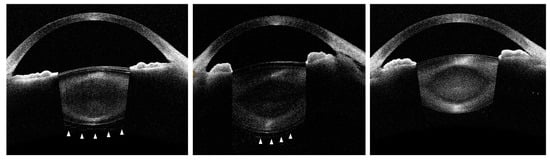 Detection of Anterior Hyaloid Membrane Detachment Using Deep-Range ...