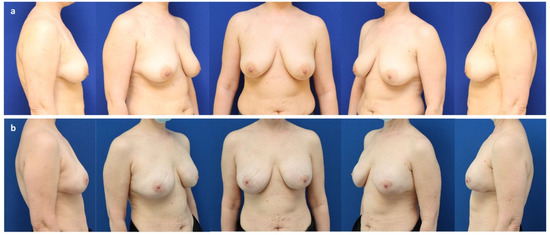Vertical displacement of small and large breasts during different