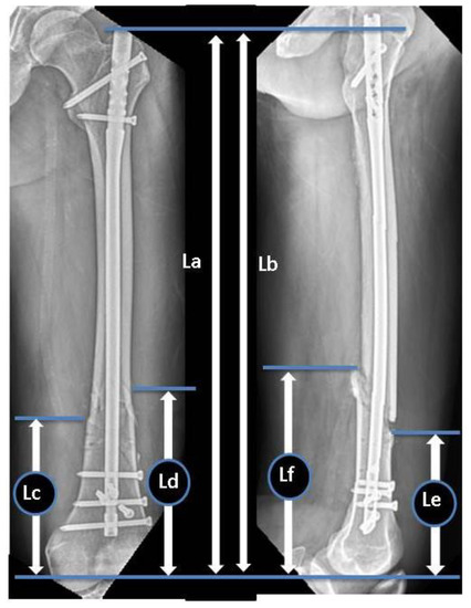 A multicenter study of factors affecting nonunion by radiographic analysis  after intramedullary nailing in segmental femoral shaft fractures |  Scientific Reports