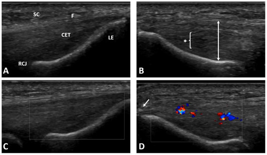 JCM | Free Full-Text | Effectiveness of Lateral Elbow Tendinopathy ...