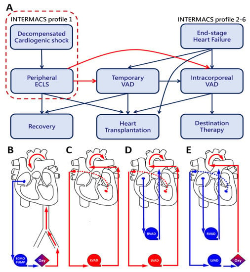 Extracorporeal Life Support and Temporary CentriMag Ventricular Assist ...