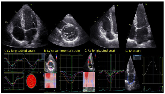 Strain Echocardiography in Acute Cardiovascular Diseases - The Western  Journal of Emergency Medicine