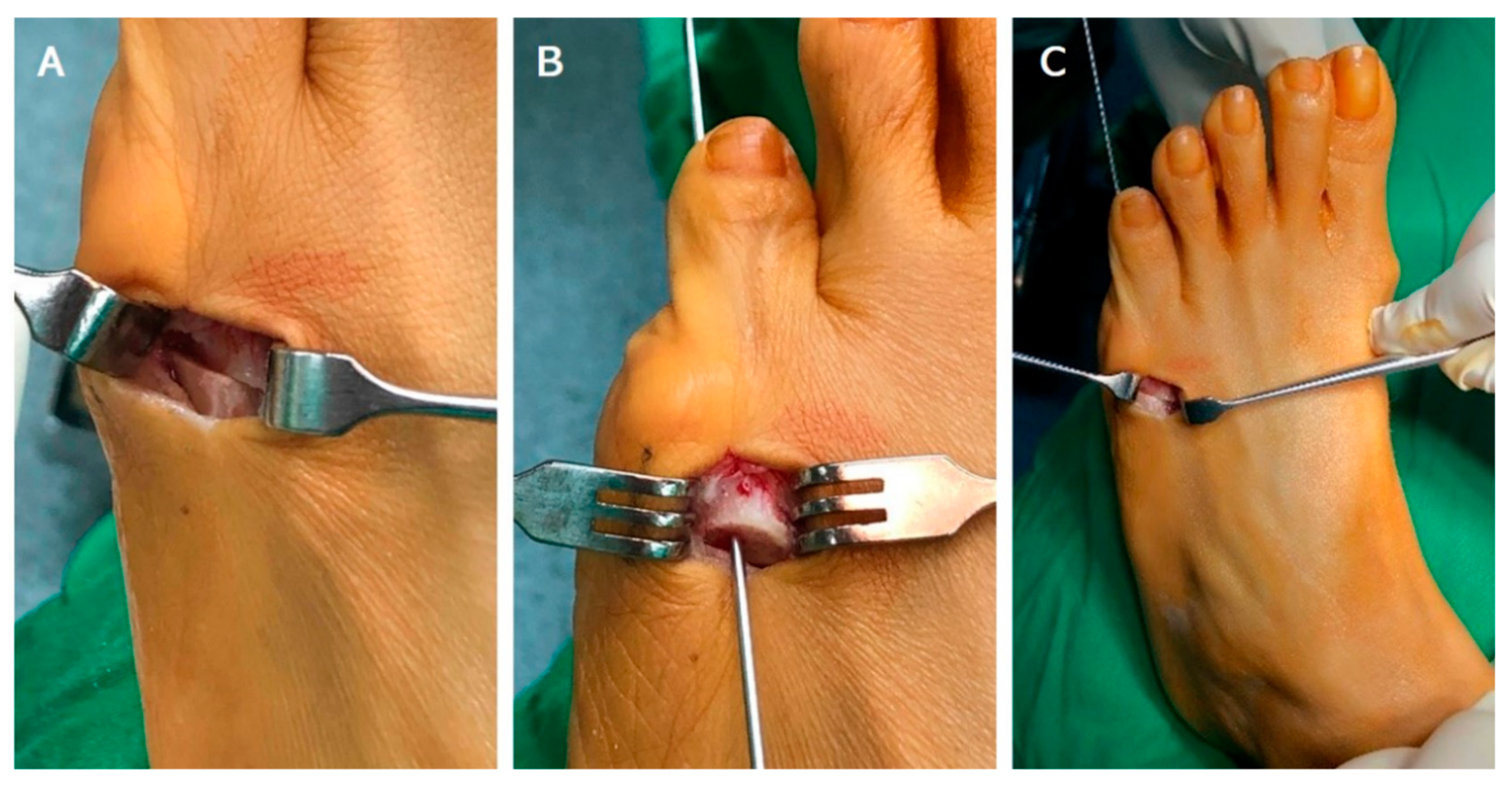JCM | Free Full-Text | Symptomatic Bunionette Treated with Sliding Oblique  Metatarsal Osteotomy—Case Series