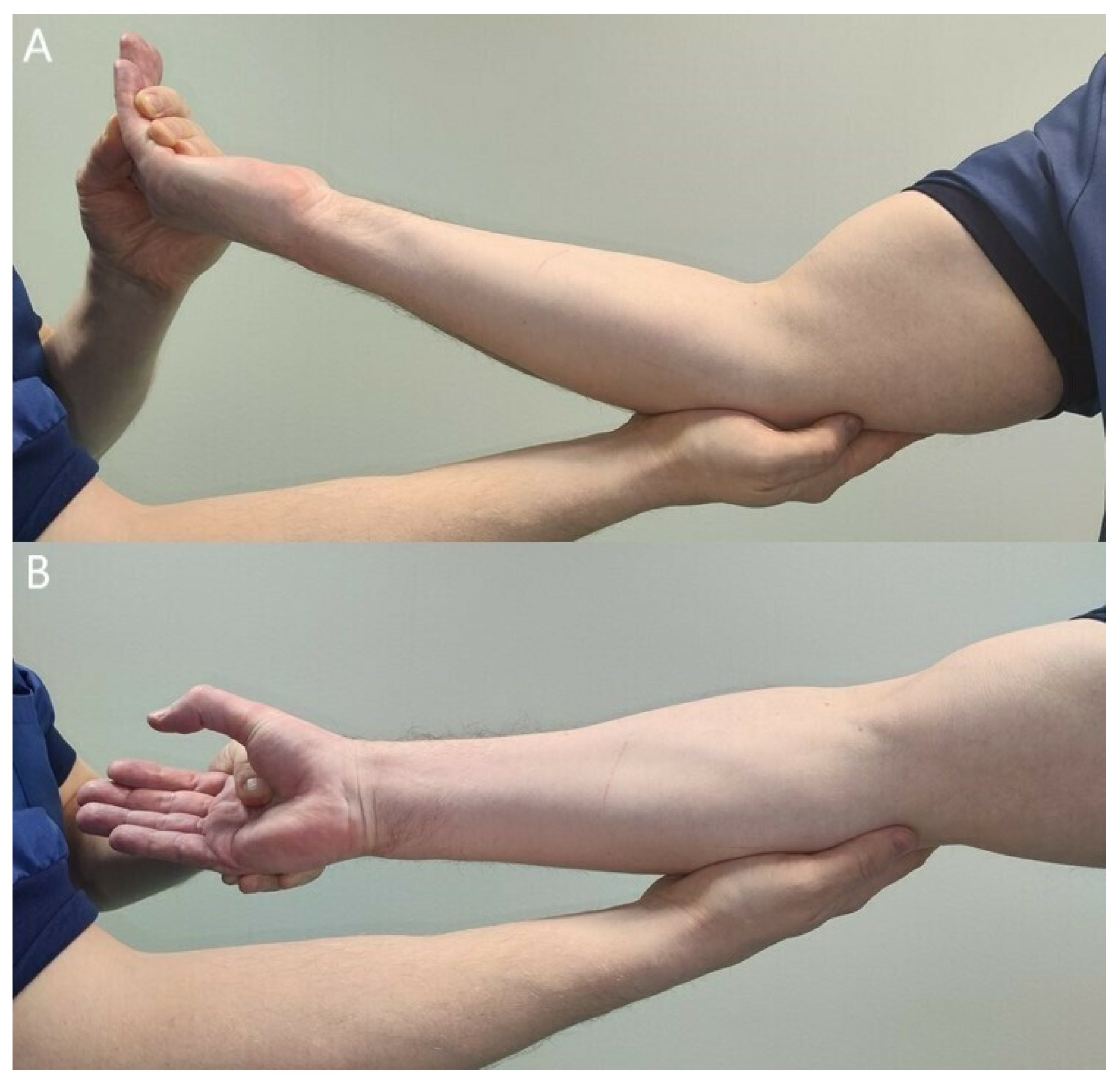 Differentiating Proximal Median Nerve Entrapment from CTS