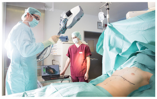 PDF] Breast Augmentation Virtual Surgery Using 3D Body Scanning