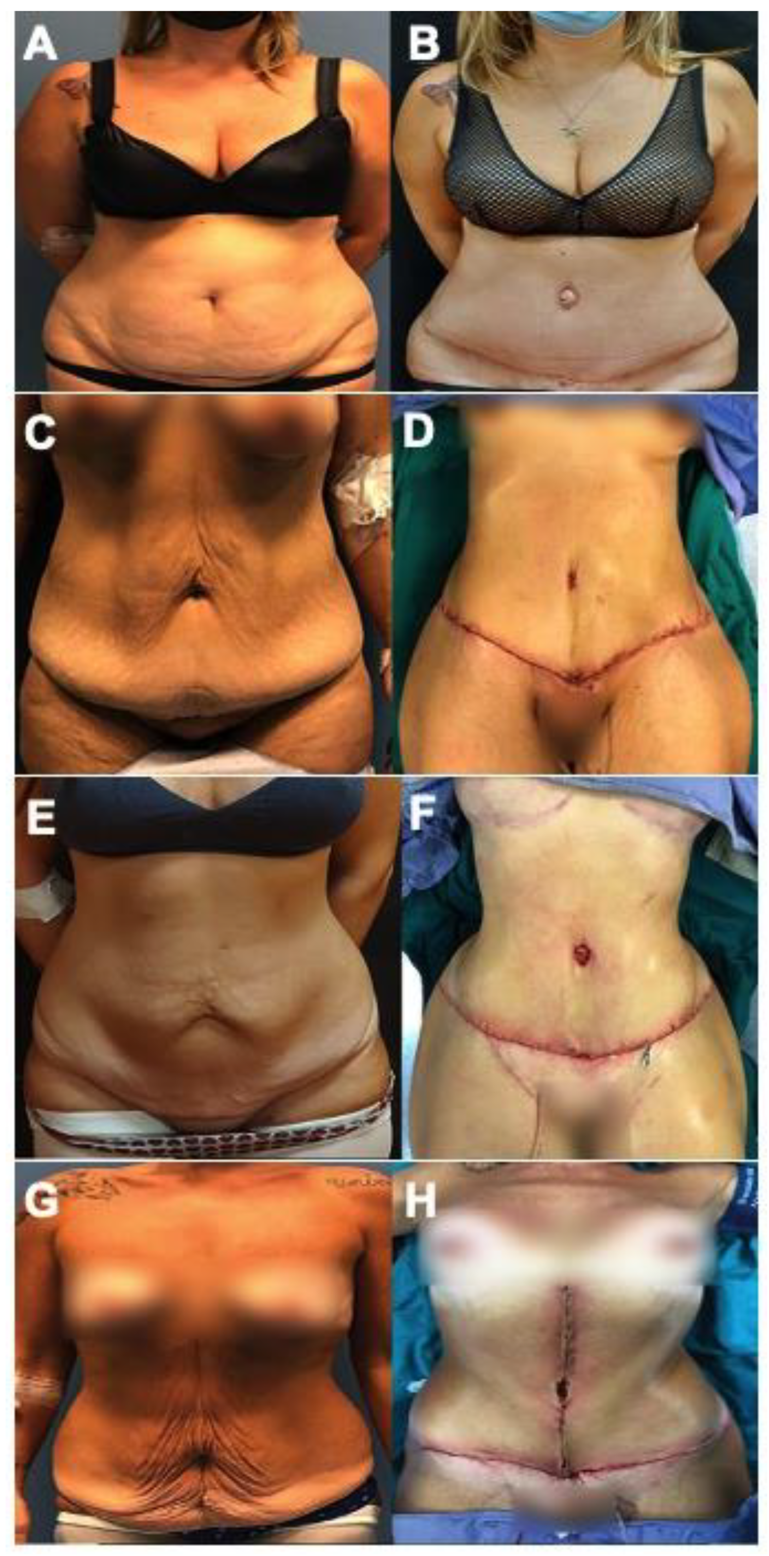 Jcm Free Full Text Post Bariatric