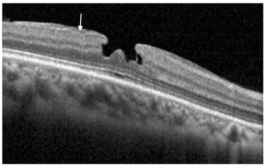 Primary Lamellar Macular Holes: To Vit or Not to Vit