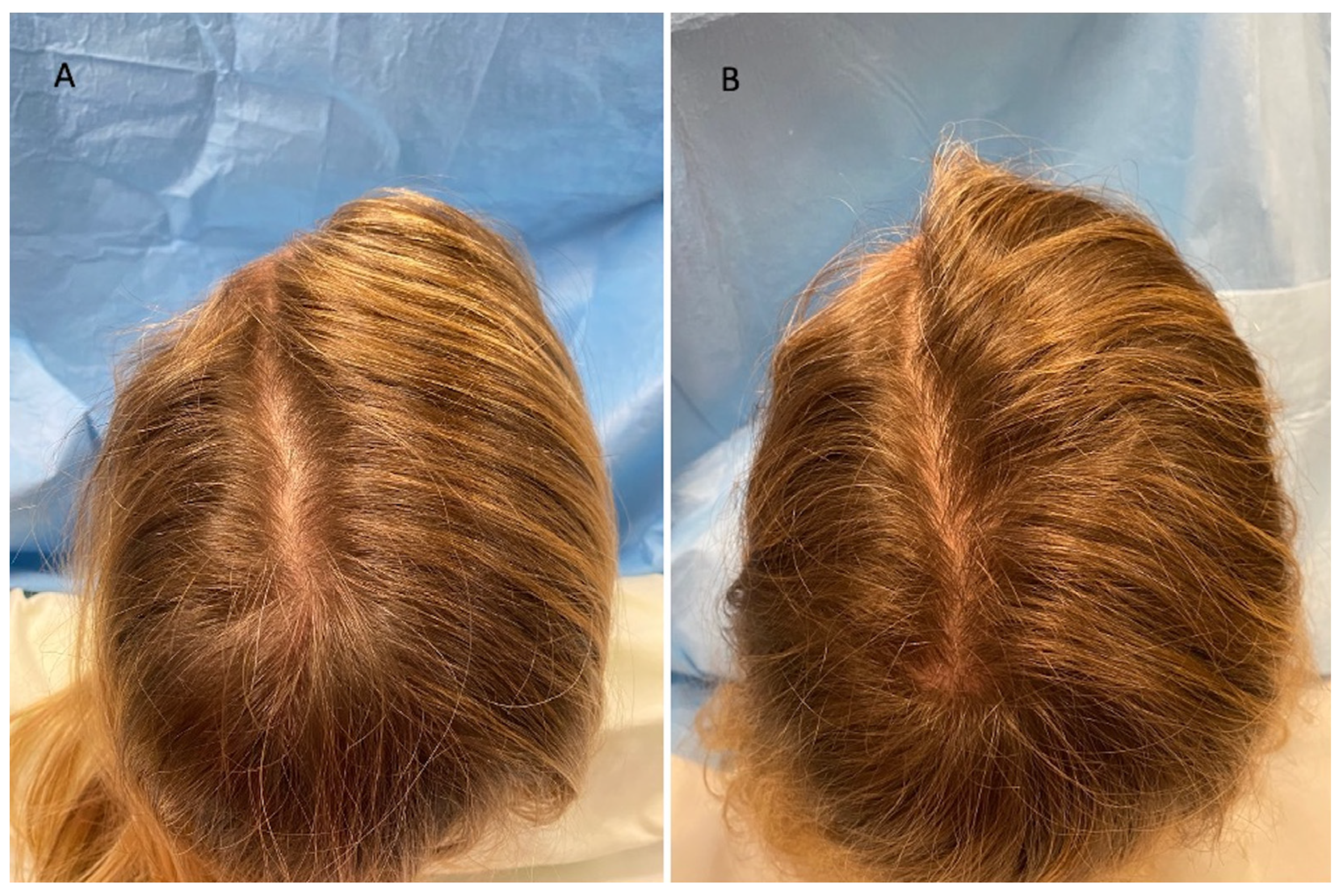 JCM | Free Full-Text | Preliminary Investigation on Micro-Needling with  Low-Level LED Therapy and Growth Factors in Hair Loss Related to COVID-19