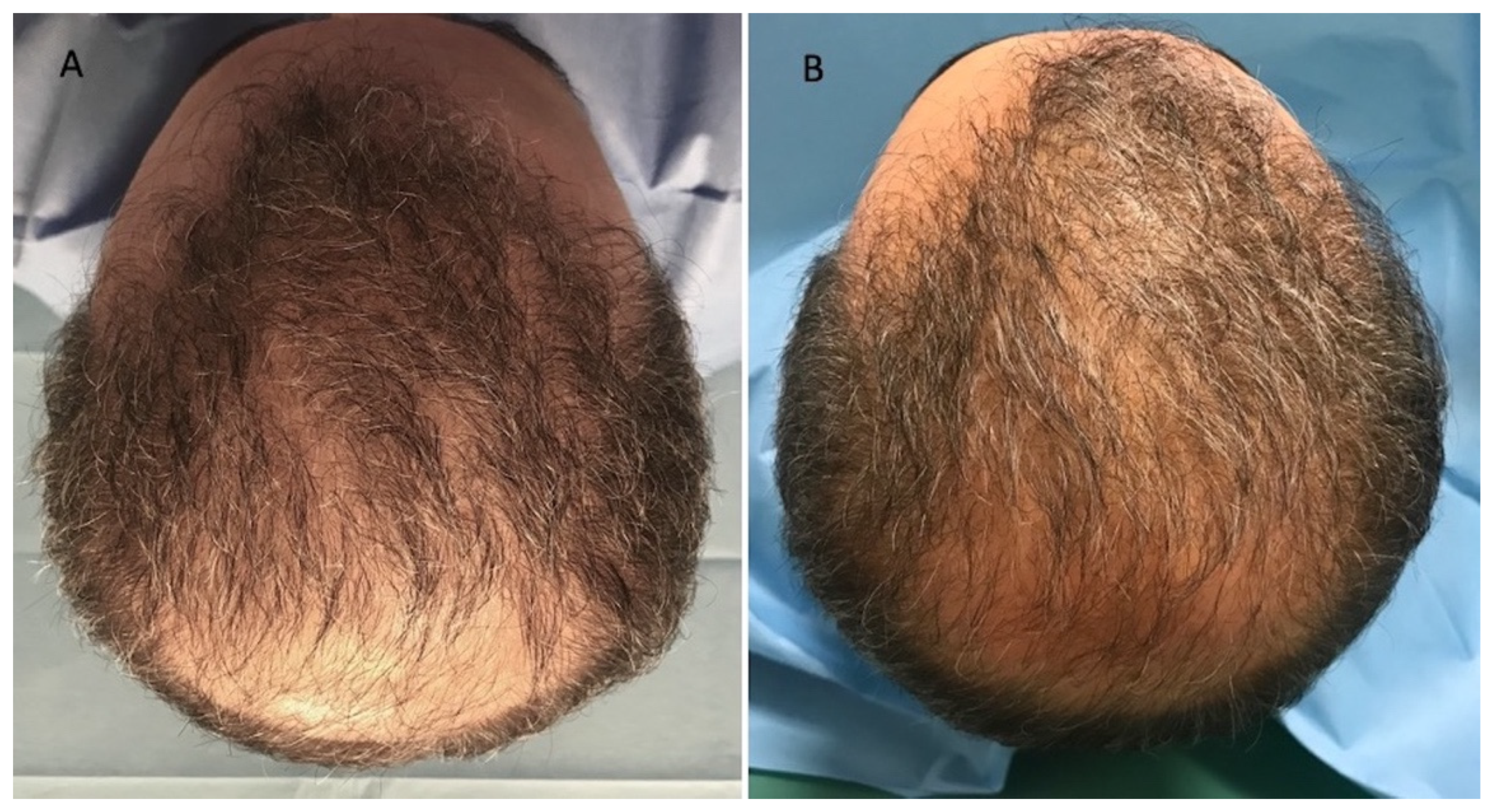JCM | Free Full-Text | Preliminary Investigation on Micro-Needling with  Low-Level LED Therapy and Growth Factors in Hair Loss Related to COVID-19