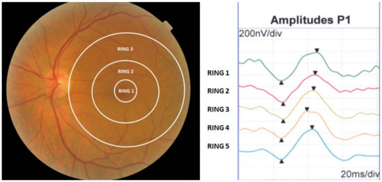 Differences in Multifocal Electroretinogram Study in Two Populations of ...