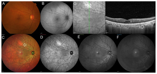 JCM | Free Full-Text | Choroidal Melanocytic Hamartoma