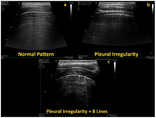 JCM | Free Full-Text | Lung Ultrasound Findings In Healthy Children And ...