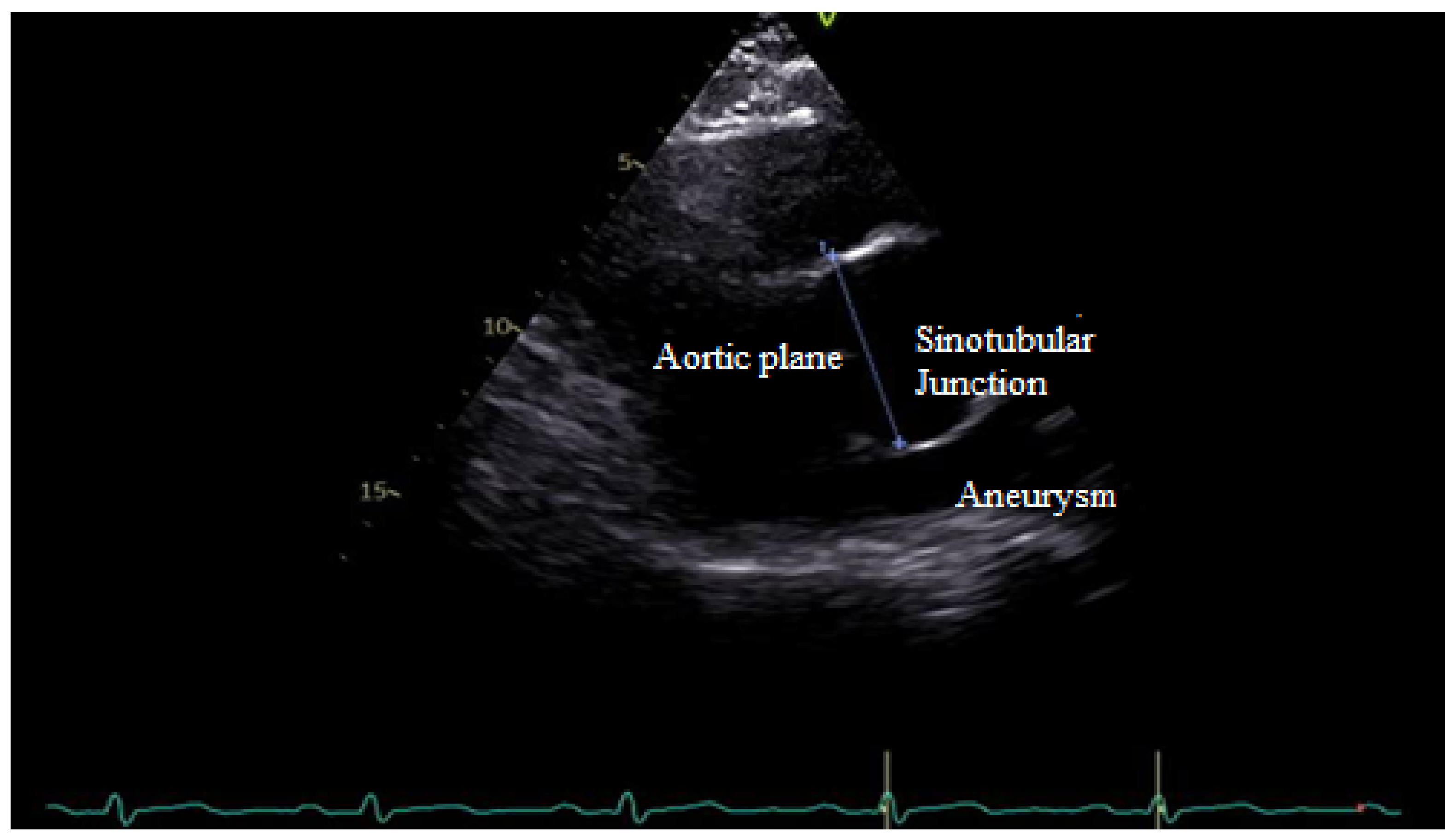 thoracic aortic aneurysm echocardiogram